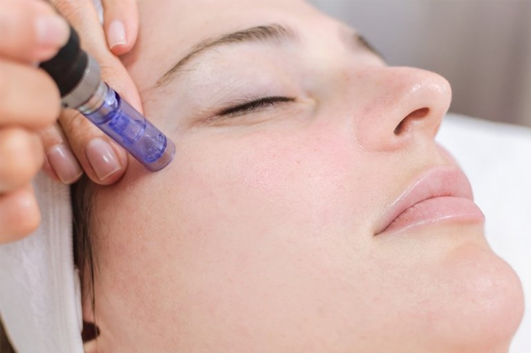 Limpieza Facial Deluxe Senza con Dermapen
